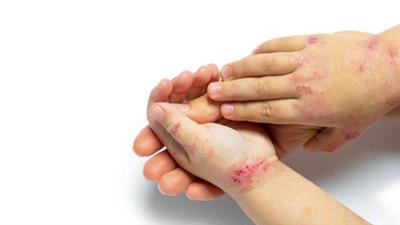 Eliminate  Eczema 920ccdbffd991e857ca0d3e539eb0c4b