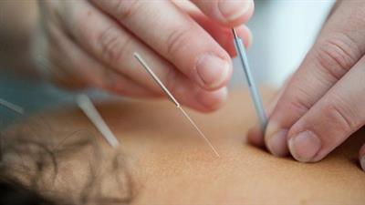 Dry Needling The  Shoulder