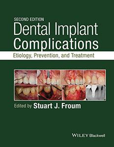 Dental Implant Complications Etiology, Prevention, and Treatment 