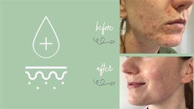 Adult Acne: Skincare For Clear  Skin
