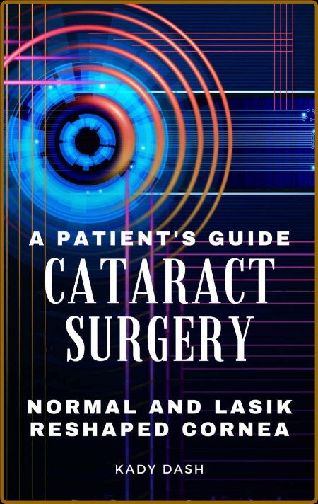 A Patient's Guide to Cataract Surgery - Normal and LASIK Reshaped Cornea