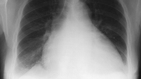 A 62 Year Old Lady With Increasing Shortness Of Breath