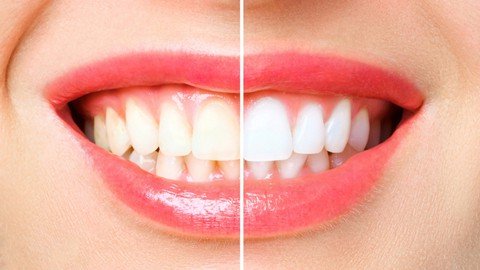 Tooth Whitening- A Dental Makeover